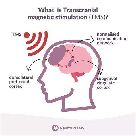 versace 2017 parkinson tms|Transcranial magnetic stimulation and gait disturbances in .